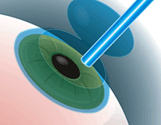 lasik eye surgery - source - providence eye